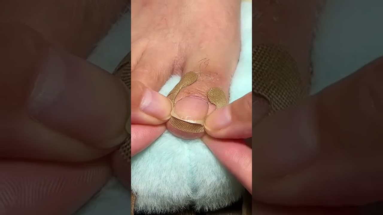 Toe Align Ingrown Nail Corrector Stickers( # 2609  ) 1️⃣ Product Link in Bio